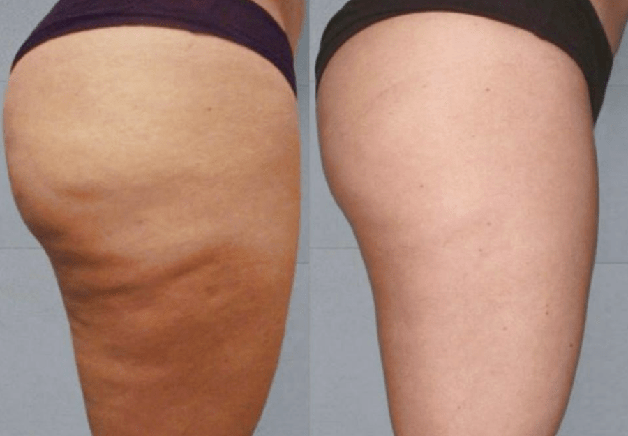 ICOONE Laser Technology Innovative Approaches to Cellulite Reduction Efficacy and Safety of ICOONE for Body Contouring seo1337.com